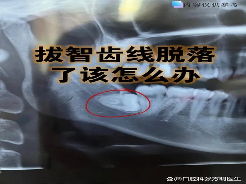 韦林顿确诊上唇部贯通伤；11、21牙半脱位；上颌前牙区牙槽骨骨折